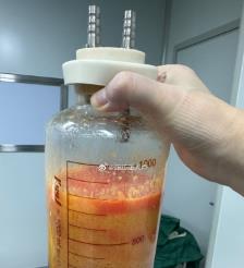 遵化市水动力吸脂手术要做多久？
